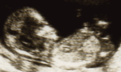  胎児 エコー 画像
