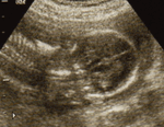  胎児 エコー 画像