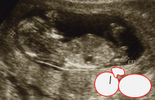 妊娠4ヶ月 胎児 エコー 画像　女の子