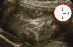 妊娠5ヶ月 胎児 エコー 画像　女の子